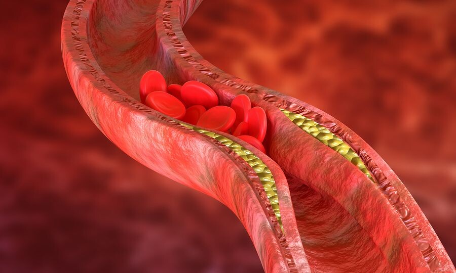 Ποια δίαιτα «ξεβουλώνει» τις αρτηρίες