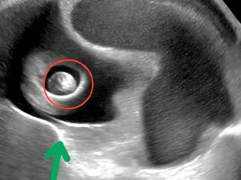 Ζήτησα από τη γειτόνισσά μου να προσέχει την κόρη μου μόνο για είκοσι λεπτά, όσο θα έκανα μερικές γρήγορες δουλειές. Όταν όμως γύρισα, βρήκα τη Σοφία να ουρλιάζει από πόνο στην κοιλιά. Ο γιατρός στο νοσοκομείο έδειχνε σοκαρισμένος