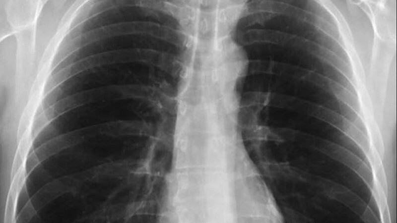 Τι είναι το σύνδρομο λευκού πνεύμονα: Η μυστηριώδης κινέζικη πνευμονία που προκαλεί ανησυχία και στην Ελλάδα