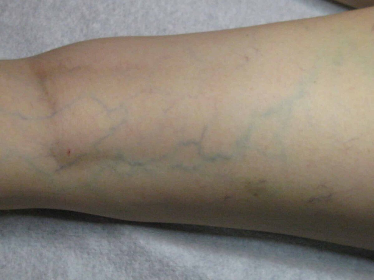 Αν δείτε κάποιον με διογκωμένες φλέβες