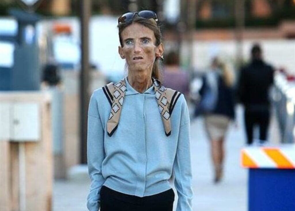 «Μάχη κατά της ανορεξίας!» Ο τρόπος που έμοιαζε το κορίτσι πριν από την ανορεξία άφησε τους πάντες άφωνους