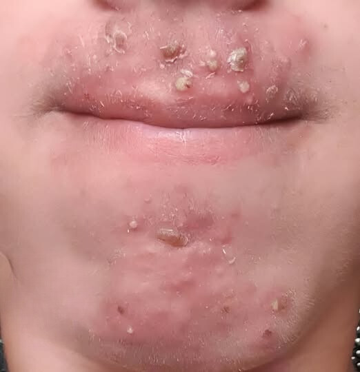 Έβγαινα με μια γυναίκα που γνώρισα στο σουπερμάρκετ και αφού τελικά πήγα μαζί της ξύπνησα με αυτά στο πρόσωπό μου. Τι είναι αυτό;