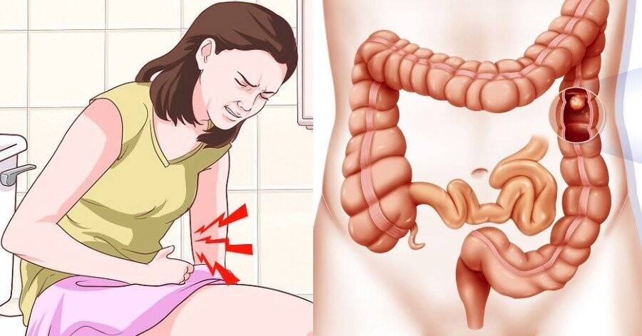 Απόφραξη του Εντέρου: Σημάδια που σας Προειδοποιούν