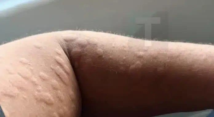 Τι είναι, πώς εμφανίζεται και πότε χρειάζεται ιατρική επίβλεψη