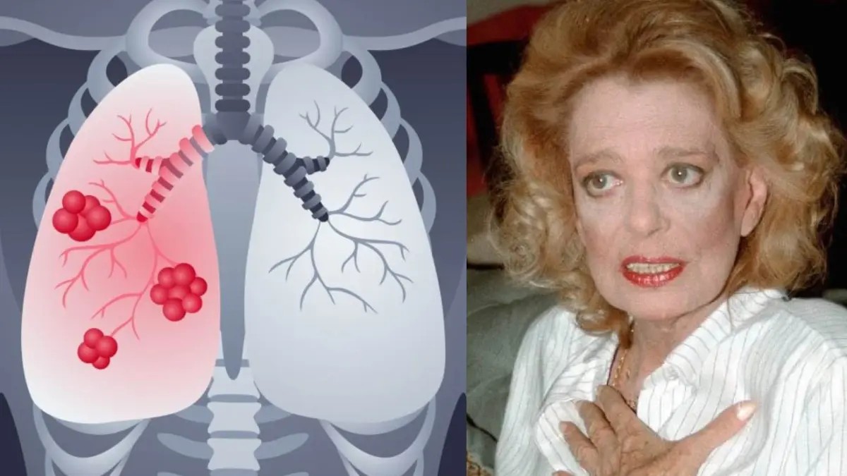 Καρκίνος του πνεύμονα: Τα ύπουλα συμπτώματα που… σκότωσαν την Μελίνα Μερκούρη – Τροφές που μπορούν να τον προκαλέσουν