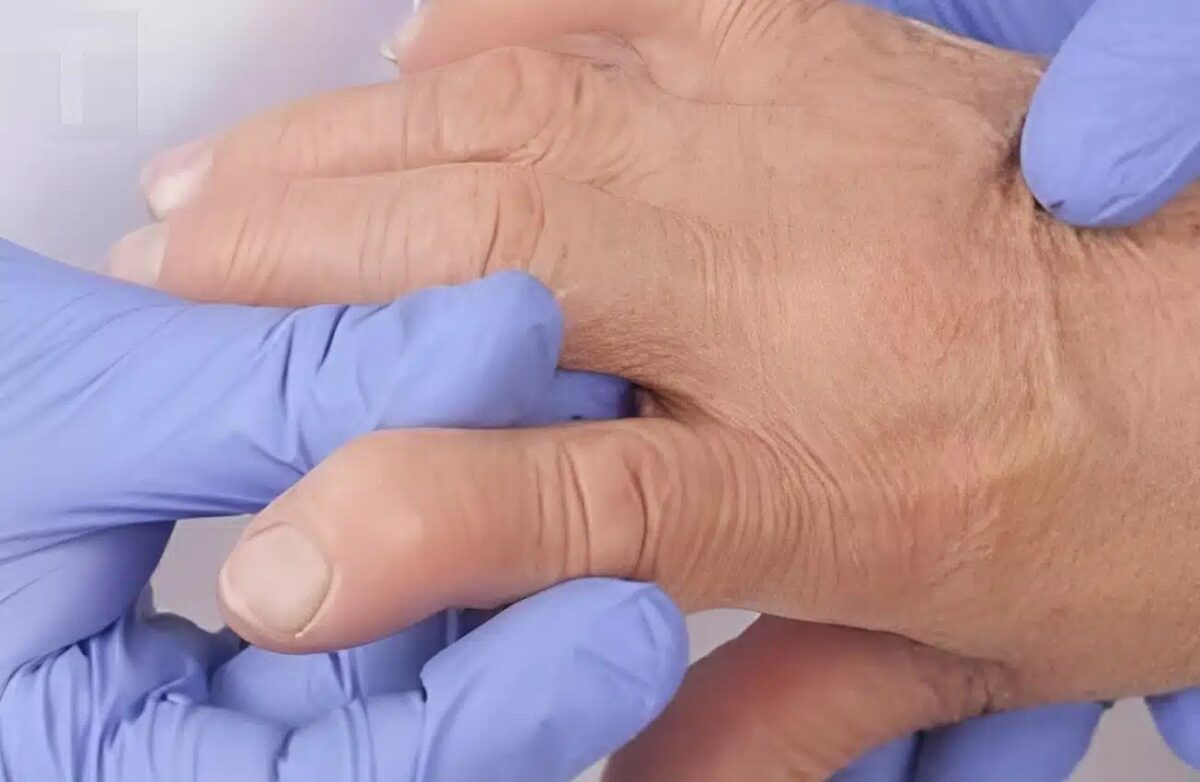 Τρόφιμα που πρέπει να αποφύγετε όταν έχετε ρευματοειδή αρθρίτιδα