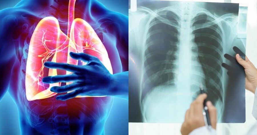 4 μύθοι για τον καρκίνο του πνεύμονα που πρέπει να πάψουμε να πιστεύουμε