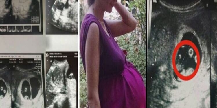 Όταν οι γιατροί είδαν το υπερηχογράφημα 36χρονης εγκύου φοβήθηκαν να την αγγίξουν – Δεν είχαν αντιμετωπίσει ποτέ κάτι παρόμοιο