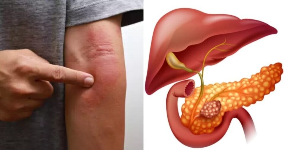 Το περίεργο σημάδι στο δέρμα που «δείχνει» καρκίνο στο πάγκρεας – Γρήγορα για εξετάσεις