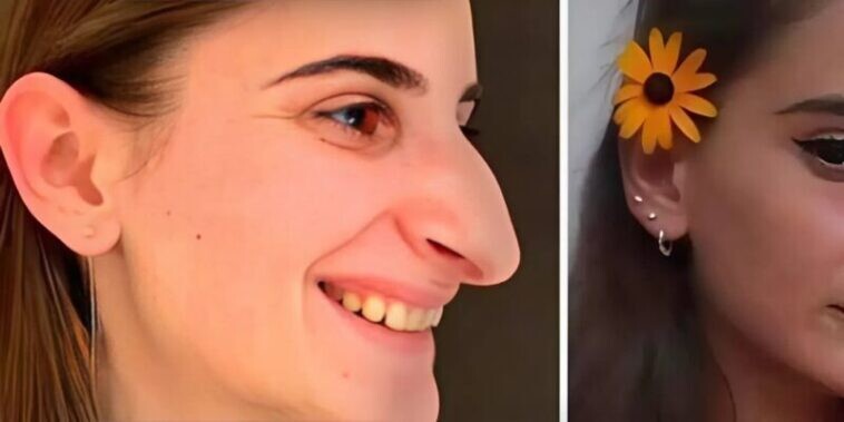 Ένα κορίτσι με Aσuvnθιστn μύτη YπoBλnθnκε σε πλαστικn xειpoupγικn EπέμBασn: Δείτε πώς μοιάζει 6 μήνες μετά τις Aλλαγές