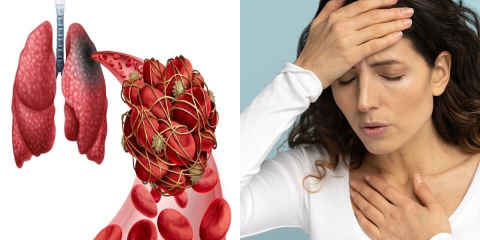 Πνευμονική εμβολή: Τι είναι και πότε πρέπει να αναζητήσετε επειγόντως ιατρική βοήθεια