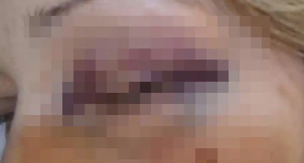 Λευκάδα: «Θα το ξαναέκανα και με μωβ μάτι» λέει η δασκάλα μετά τον άγριο ξυλοδαρμό