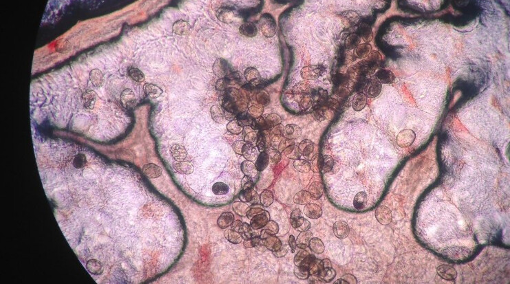 Τρόμος από παρασιτικό σκουλήκι: Προκαλεί καρκίνο και εισβάλλει στο σώμα… χωρίς να το καταλάβεις