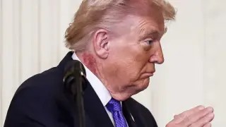 Παγκόσμια Ανησυχία για την υγεία του Ντόναλντ Τραμπ – Τι σημαίνει το εξάνθημα που έχει στο λαιμό του