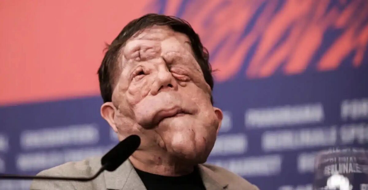 Xαμoς στα Όσκαρ: Πασίγνωστος ηθοποιός εμφανίστηκε με Auτo το πρόσωπο και… πάγωσαv όλοι – Η σπάνια Appώστια που τον «xτuπnσε»