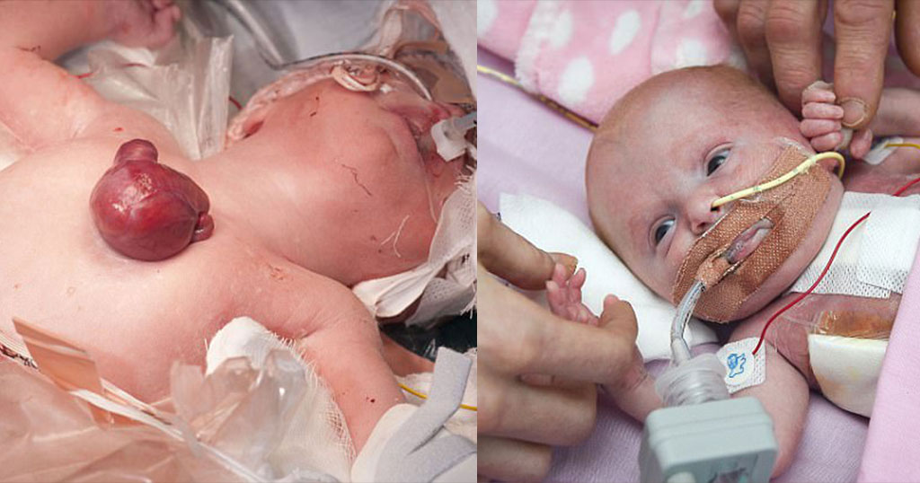 Πρόωρο μωρό γεννήθηκε με την καρδιά του έξω από το σώμα και είναι το πρώτο που επιβίωσε παγκοσμίως