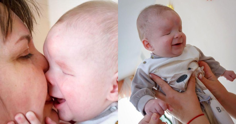 Το γελαστό μωρό χωρίς μάτια βρήκε σπίτι – Το εγκατέλειψε η μητέρα του μόλις γεννήθηκε