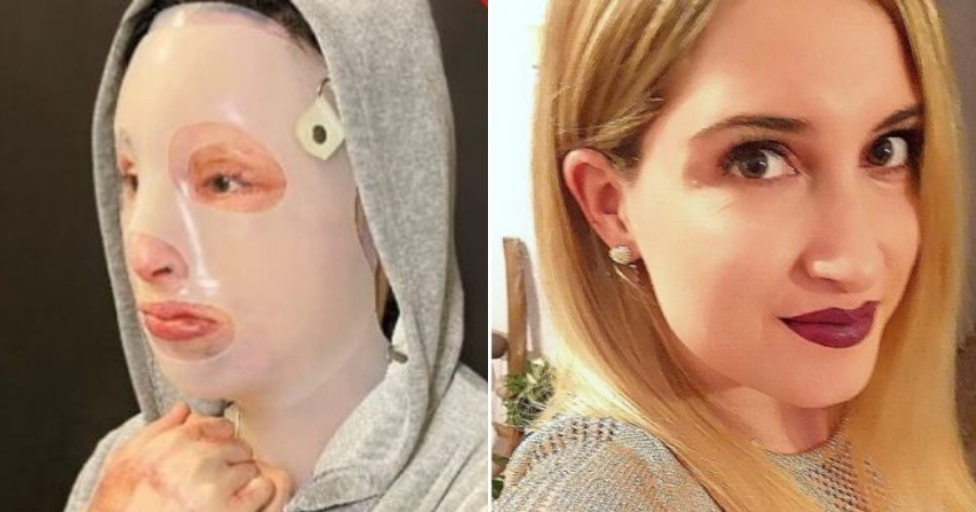 Εικόνα που κόβει την ανάσα: Η 35χρονη Ιωάννα αποκαλύπτει το πρόσωπο της μετά την επίθεση με το βιτριόλι