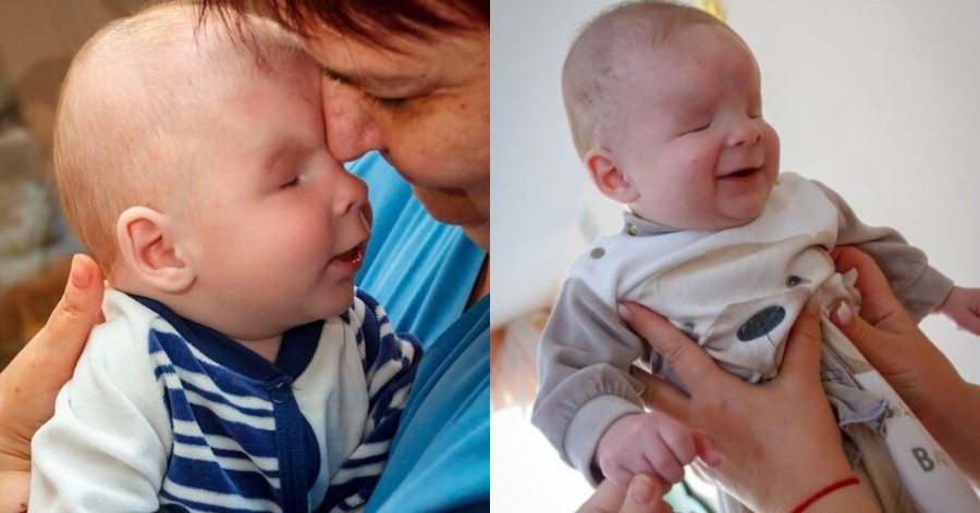Η μητέρα του το εγκατέλειψε επειδή γεννήθηκε χωρίς μάτι – Μετά την υιοθεσία του δεν σταματάει να χαμογελάει