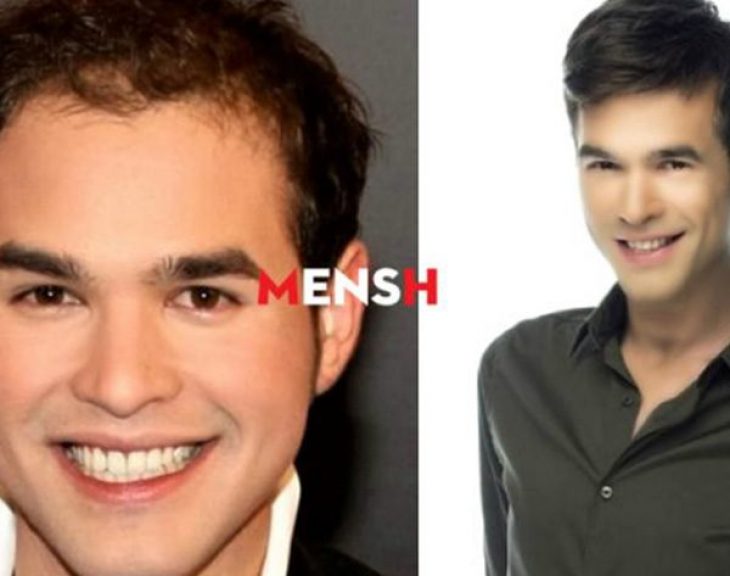 Διάσημοι Έλληνες: Οι 5 που έκαναν εμφύτευση μαλλιών
