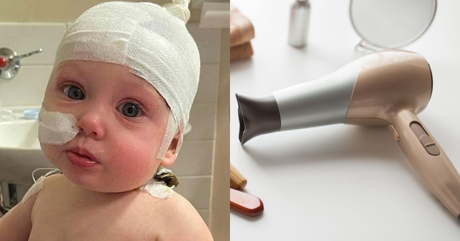 Mωρό υπέστη σοβαρά εγκαύματα και τυφλώθηκε προσωρινά από σεσουάρ μαλλιών