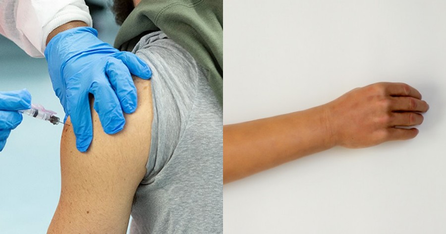 Απίστευτο περιστατικό στην Ιταλία: Με ψεύτικο χέρι σιλικόνης παρουσιάστηκε 50χρονος για να εμβολιαστεί