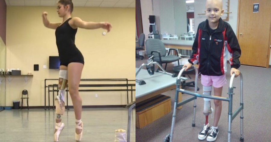 Μπαλαρίνα: Σε ηλικία 15 ετών έχασε το πόδι της από καρκίνο και σήμερα μπορεί και χορεύει ξανά