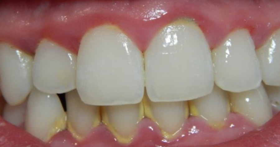 Πλάκα στα δόντια: Τα καλύτερα κόλπα με φυσικό τρόπο για να απαλλαγείτε σε χρόνο μηδέν