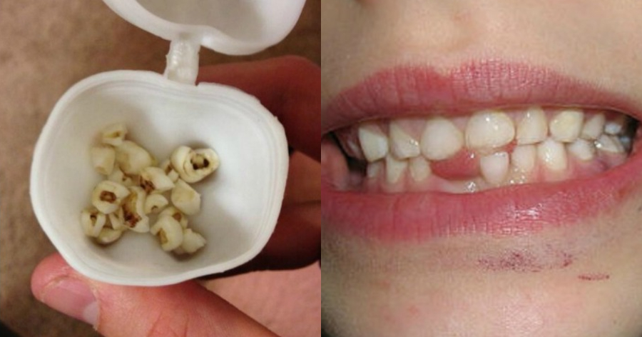 Πρώτα δόντια: Ο λόγος που επιβάλλεται να τα κρατάμε – Πως πρέπει να τα διατηρήσουμε
