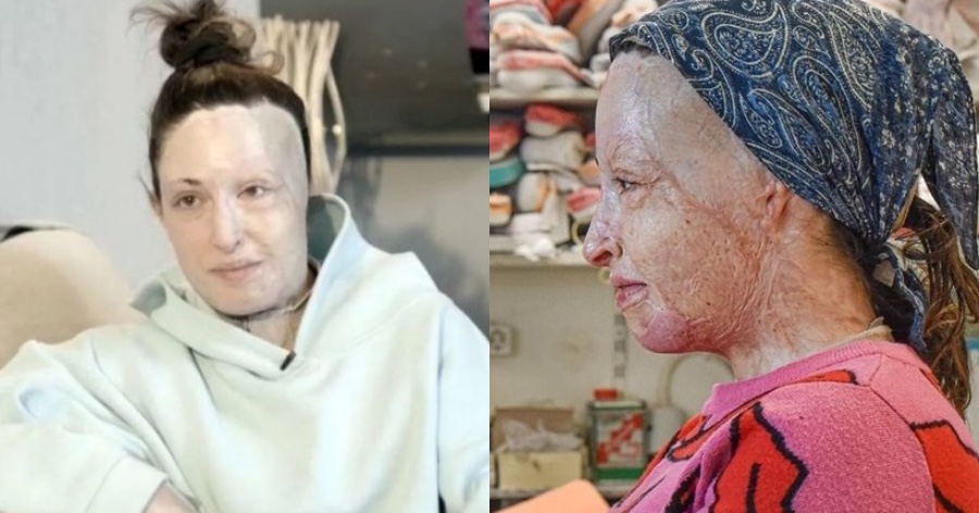 «Τους πρώτους μήνες δεν ήθελα καν να με ακουμπάω»: Η Ιωάννα Παλιοσπύρου χωρίς την μάσκα