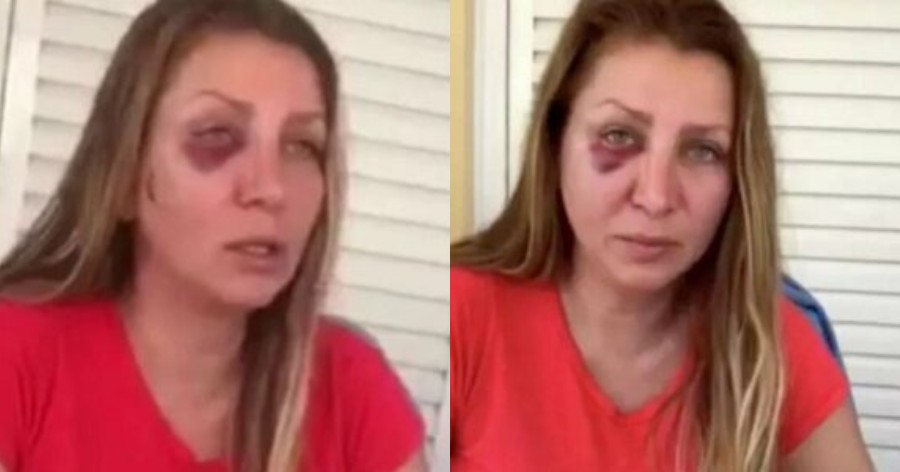 «Φοβόμαστε να μιλήσουμε ρώσικα στον δρόμο» δηλώνει στην κάμερα η Οξάνα που ξυλοκοπήθηκε από Ουκρανούς στην Αθήνα