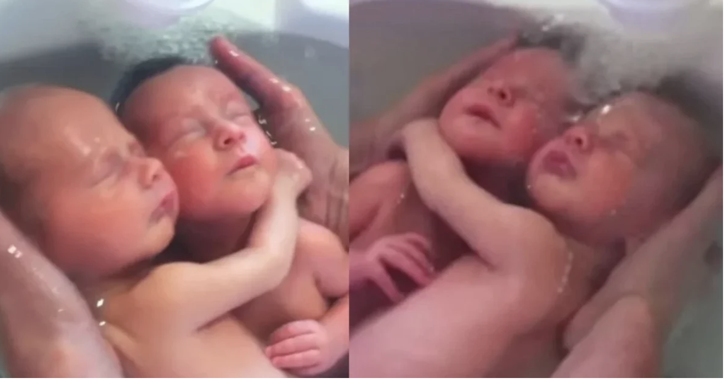 Δίδυμα μωράκια δεν έχουν καταλάβει ότι γεννήθηκαν και παραμένουν αγκαλιασμένα όπως ήταν μέσα στην κοιλιά της μαμάς τους