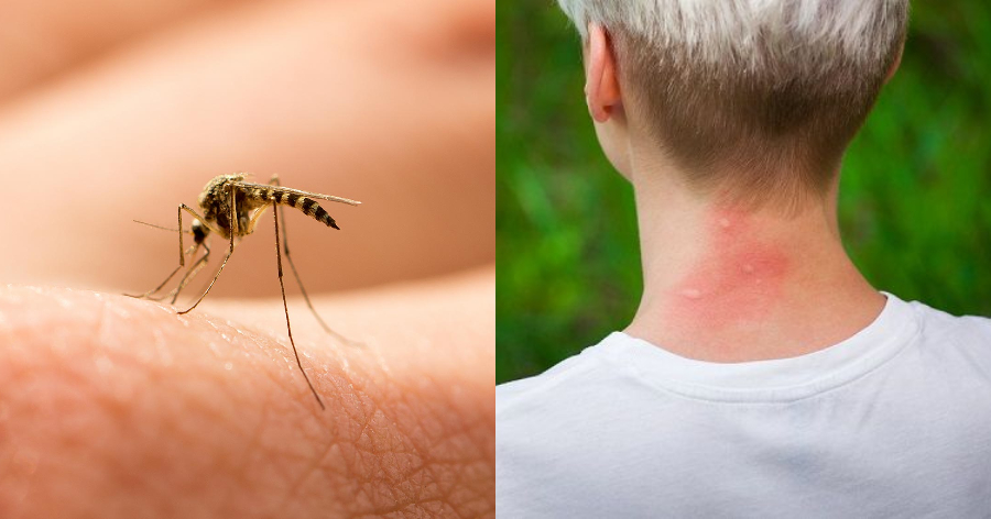 Βάλε τέλος στα κουνούπια: 4 πράγματα που τα απωθούν από το να σου ρουφήξουν το αίμα