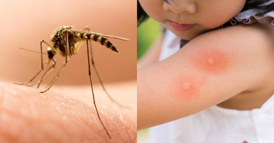 Πείτε αντίο στους ανεπιθύμητους μουσαφίρηδες: Τα 5 κόλπα που θα σε σώσουν από τα τσιμπήματα κουνουπιών