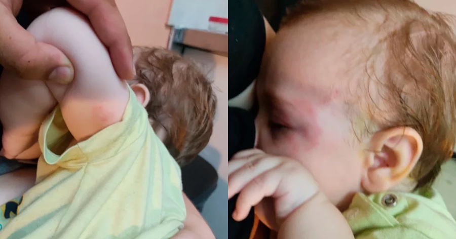 Σοκαριστική επίθεση από σκύλο σε παιδί στην Κρήτη: «Δάγκωνε με μανία το παιδί μου» – Το βρέφος έχει σκίσιμο τριών εκατοστών στο μάτι