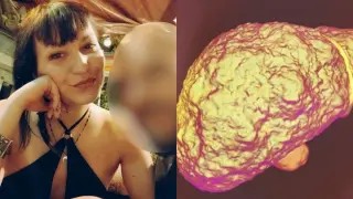 Κολωνός: Τι είναι η κίρρωση του ήπατος που «έδειξε» η ιατροδικαστική στην 31χρονη