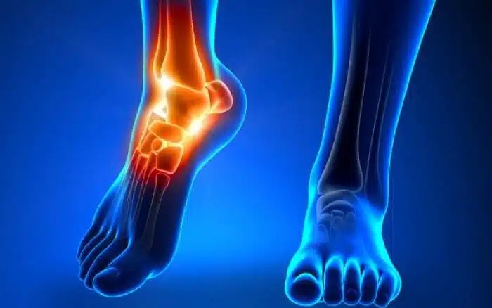 Ο χυμός που διαλύει το ουρικό οξύ στις αρθρώσεις