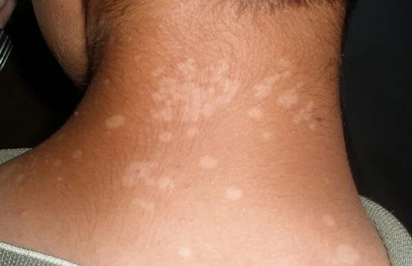 Γιατί εμφανίζονται μικρές λευκές κηλίδες στο δέρμα σας