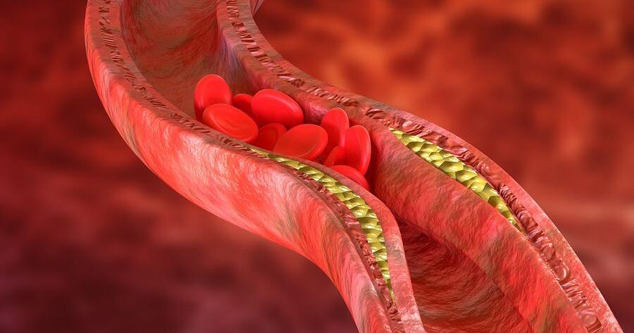 Ποια δίαιτα «ξεβουλώνει» τις αρτηρίες