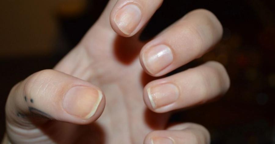 «Δείχνει» ύπουλη και θανατηφόρα καρδιακή νόσο: Αν δείτε αυτό το σημάδι στα νύχια σας, πάρτε άμεσα τον γιατρό σας