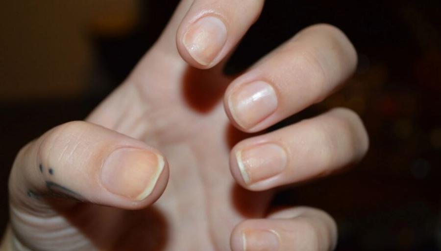 «Δείχνει» ύπουλη και θανατηφόρα καρδιακή νόσο: Αν δείτε αυτό το σημάδι στα νύχια σας, πάρτε άμεσα τον γιατρό σας