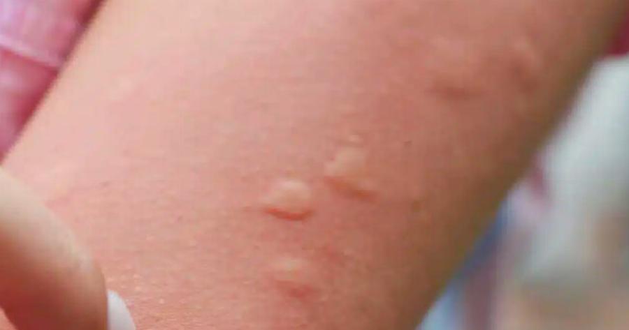 Η γιαγιά μου έμαθε αυτό το κόλπο για να απαλλαγώ από τα τσιμπήματα κουνουπιών μέσα σε δύο 2 λεπτά με 0 προσπάθεια. Να πως γίνεται