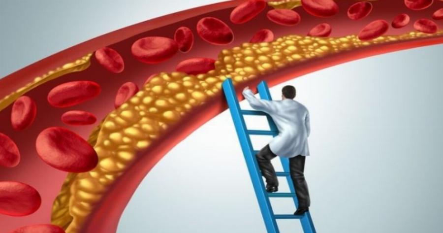 Στένωση αρτηριών: Τι να τρώτε και τι να αποφεύγετε να αναστρέψετε την καρδιακή νόσο