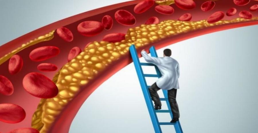 Στένωση αρτηριών: Τι να τρώτε και τι να αποφεύγετε να αναστρέψετε την καρδιακή νόσο