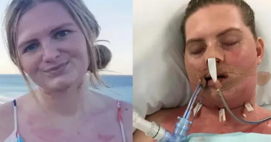 Από έναν χαλασμένο φρονιμίτη που δεν την πονούσε, παραλίγο να πεθάνει – Έπαθε σηψαιμία, τι συνέβη