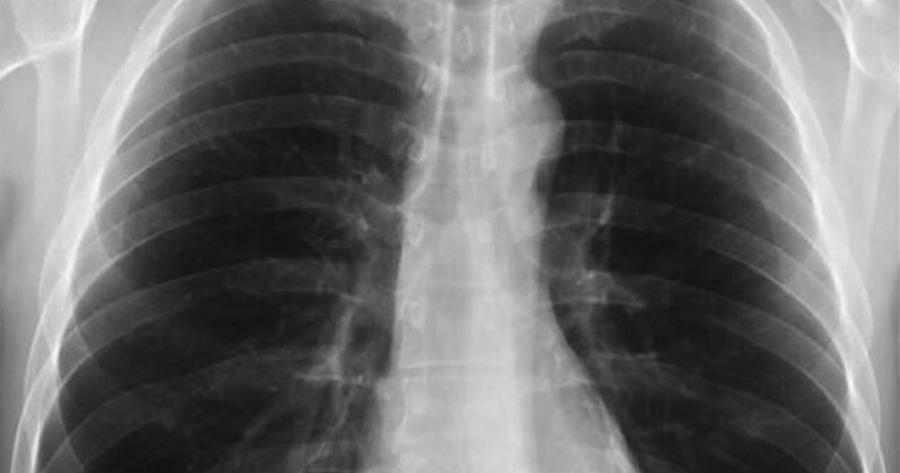 Τι είναι το σύνδρομο λευκού πνεύμονα: Η μυστηριώδης κινέζικη πνευμονία που προκαλεί ανησυχία και στην Ελλάδα