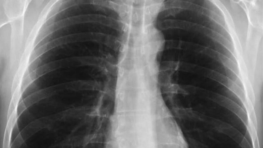 Τι είναι το σύνδρομο λευκού πνεύμονα: Η μυστηριώδης κινέζικη πνευμονία που προκαλεί ανησυχία και στην Ελλάδα