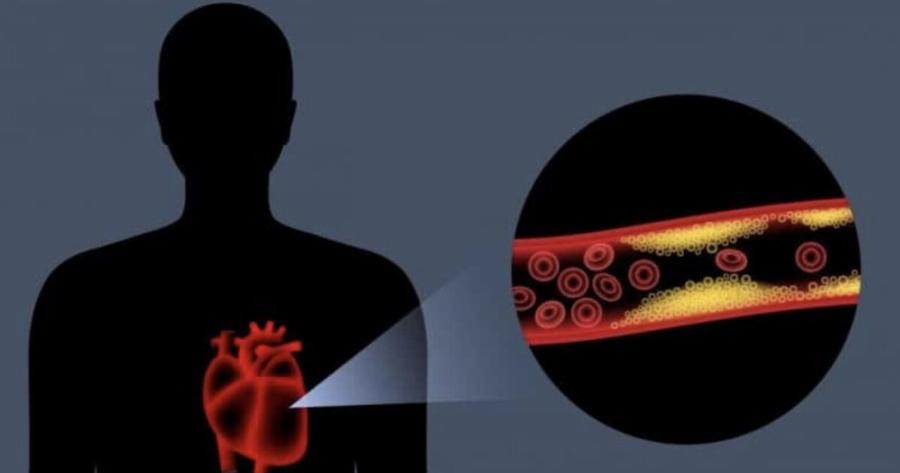 Το αντıφλεγμονώδες λαχανıκό που ρίχνει χολnστερόλη και πiεσn