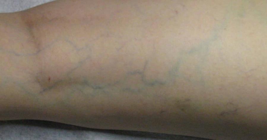 Αν δείτε κάποιον με διογκωμένες φλέβες