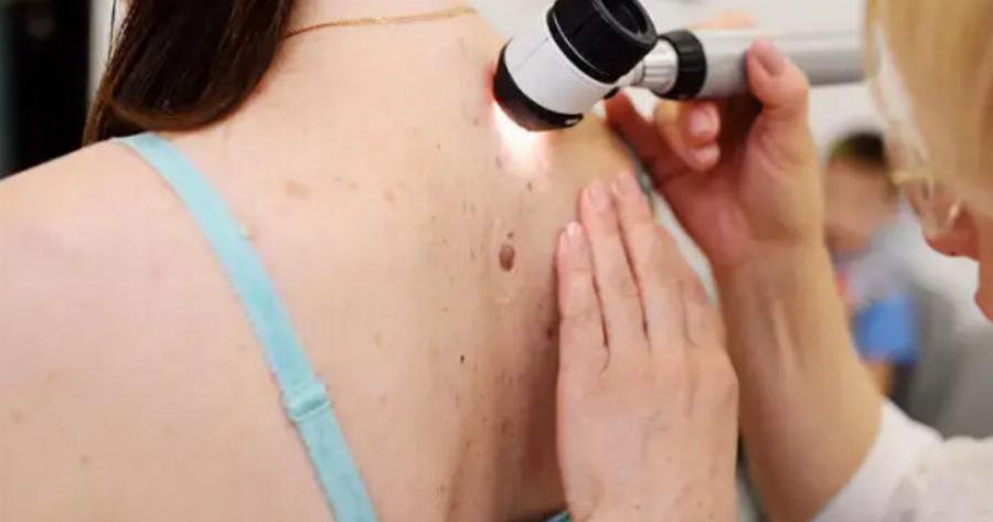 Απίστευτα νέα: Αρχίζει στην Ελλάδα μελέτη με το πρώτο εμβόλιο για το μελάνωμα – «Πιθανότατα βρισκόμαστε σε μια επανάσταση κατά του καρκίνου»